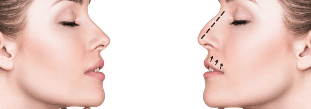 Rhinoplasty in Navi Mumbai