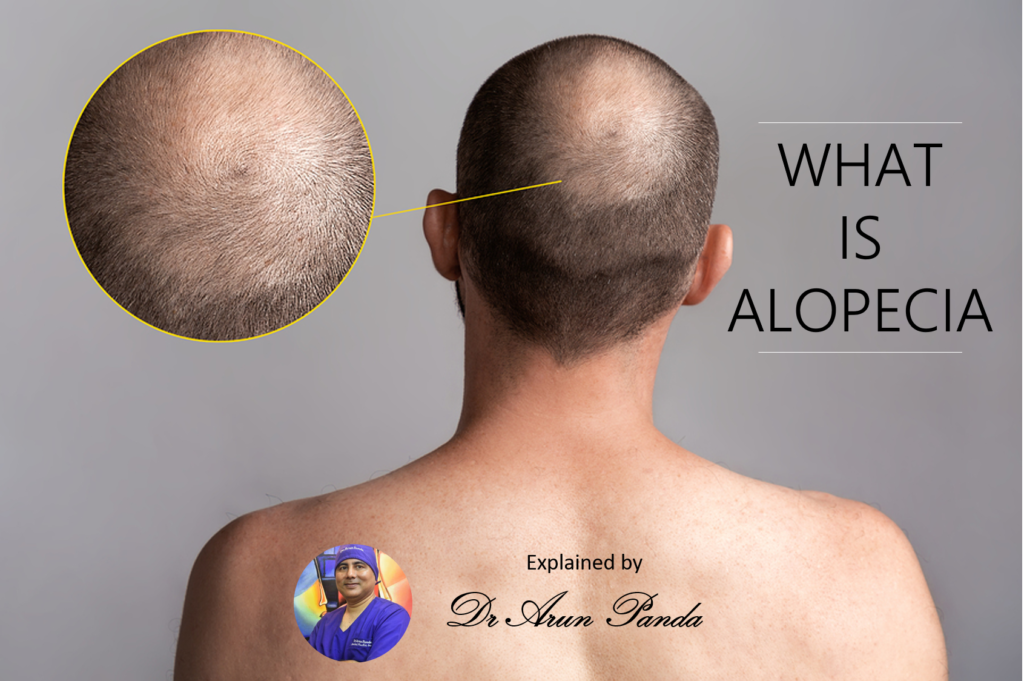 Hair Loss Treatment in Navi Mumbai
