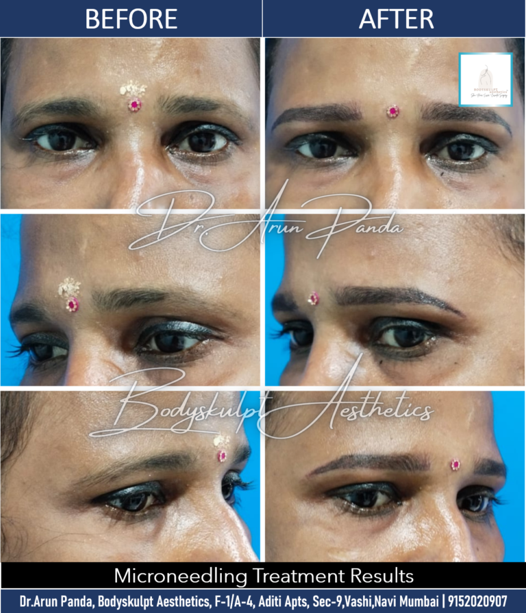 Revitalize Your Skin with Microneedling Treatment in Navi Mumbai