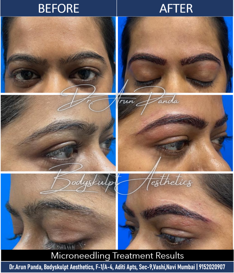 Navi Mumbai's Premier Microneedling Treatment for Glowing Skin